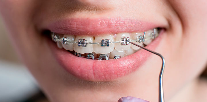 Ortodoncia fija