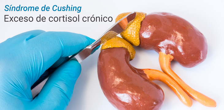 Hirsutismo de origen suprarrenal