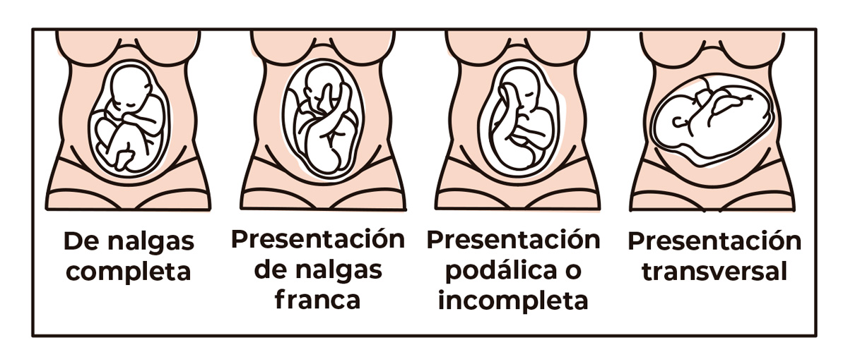 Posiciones del feto en un parto de nalgas