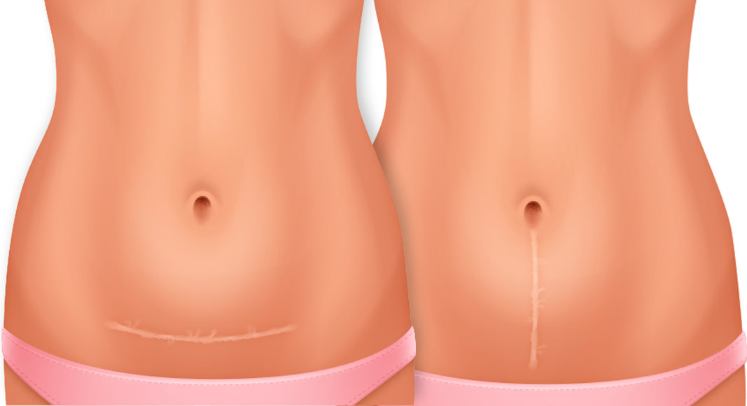 Tipos de cicatrices de la cesárea