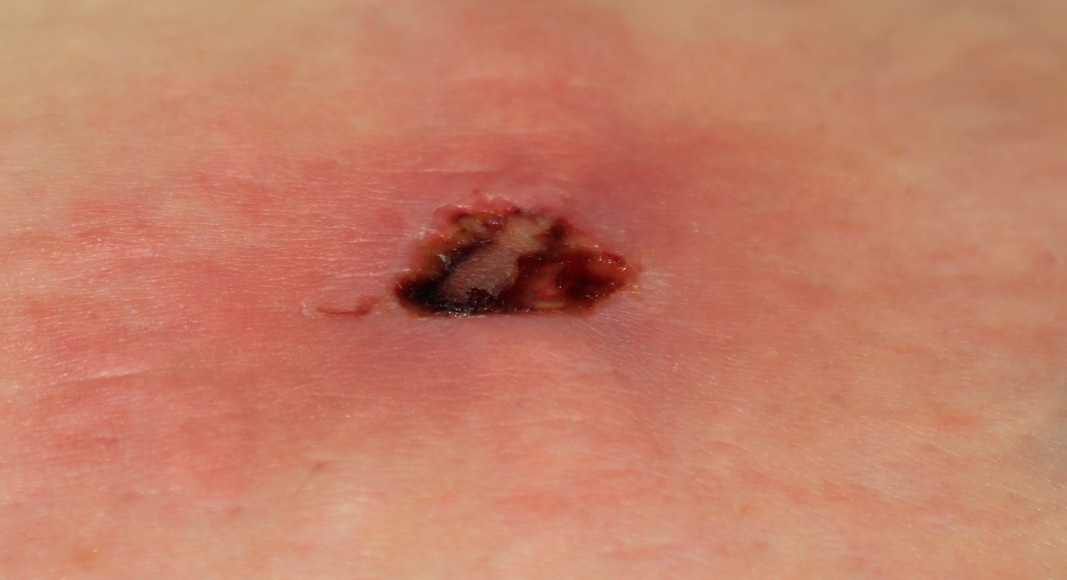 Picaduras de arañas