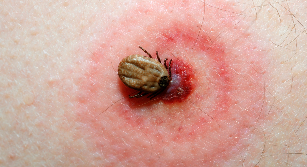 Picadura de garrapata