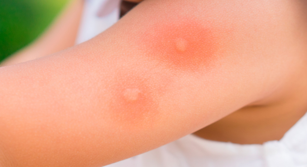 Picadura de mosquito