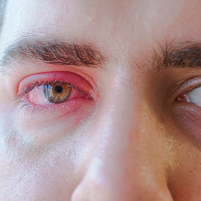 Enrojecimiento del ojo