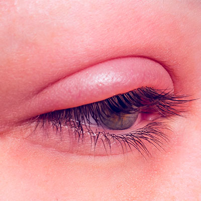 Inflamación del párpado