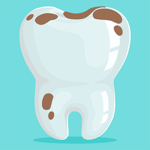 Manchas marrones en los dientes