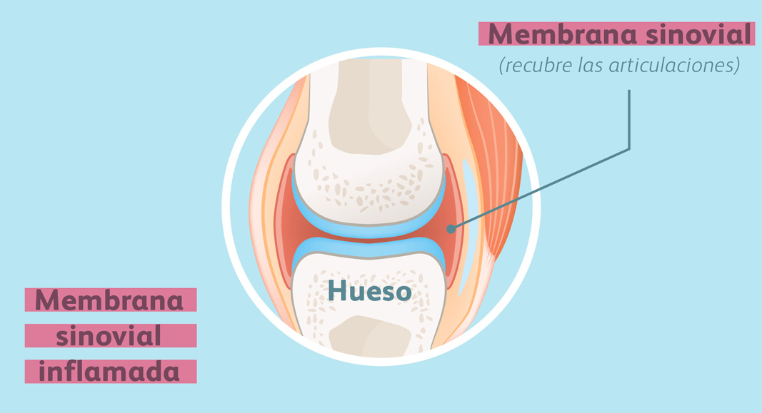 Ilustración membrana sinovial