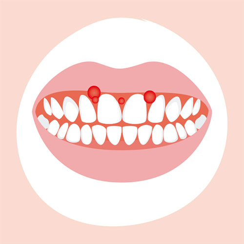 Épulis en el embarazo