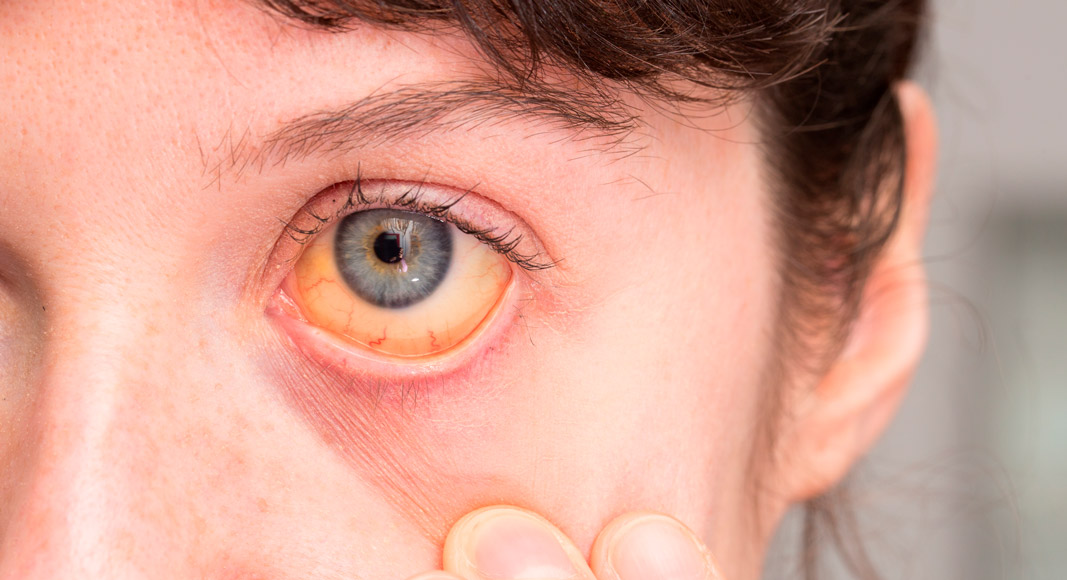 Ojos amarillentos por cirrosis
