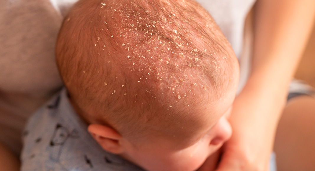 Dermatitis seborréica