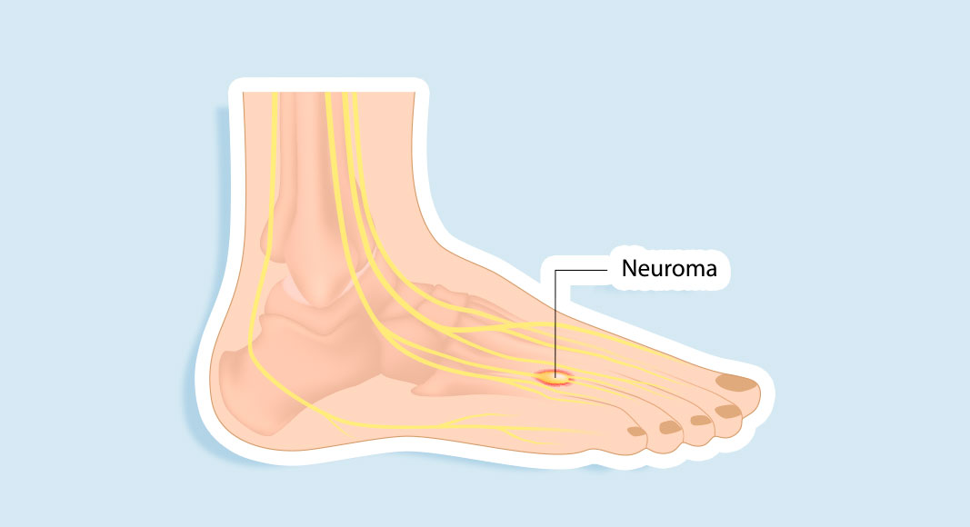 Neuroma de Morton