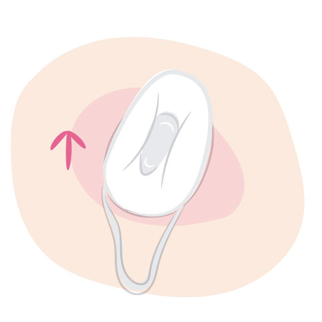 Cómo se usa la esponja anticonceptiva: colocarla hacia arriba