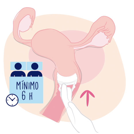 Cómo se usa la esponja anticonceptiva: dejarla al menos 6 horas