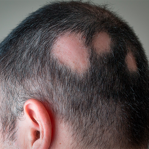 Alopecia cicatrizal