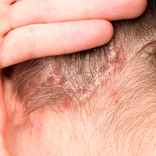 Dermatitis seborreica