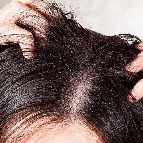 soltar Ahuyentar freno Descamación del cuero cabelludo, qué es y posibles causas