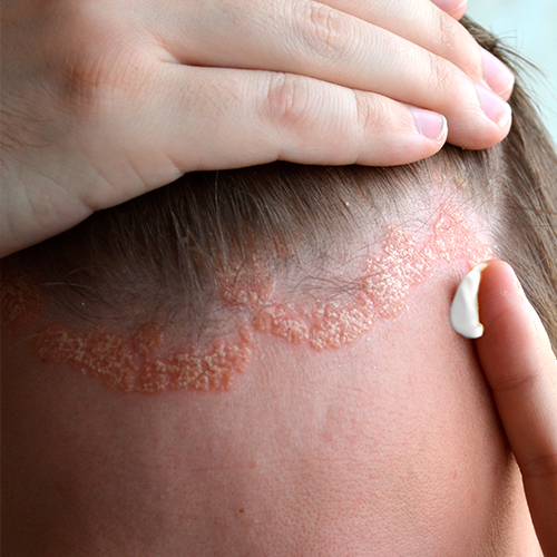 Psoriasis