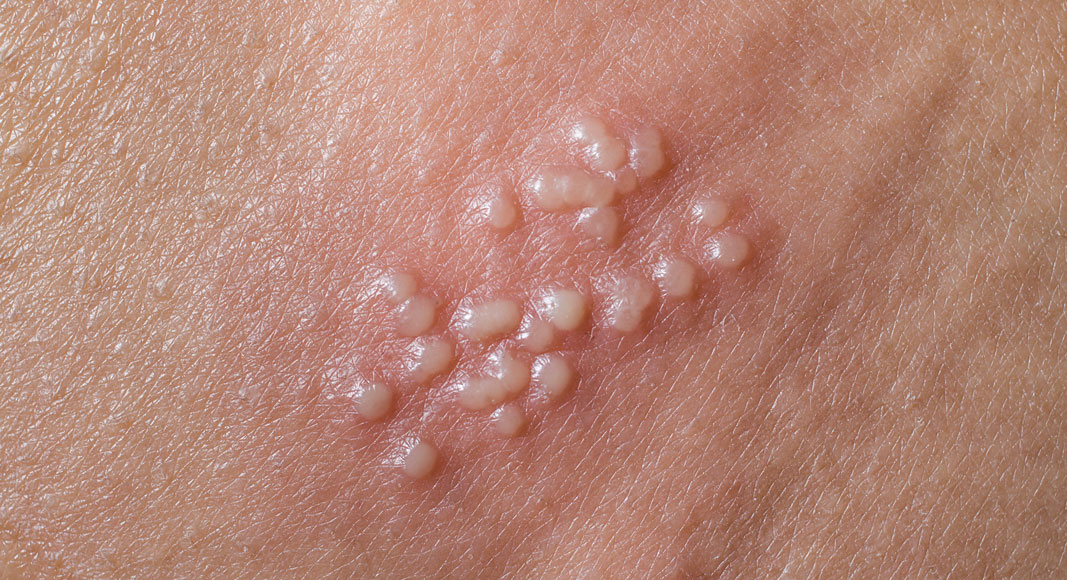 Síntomas del herpes: ampollas