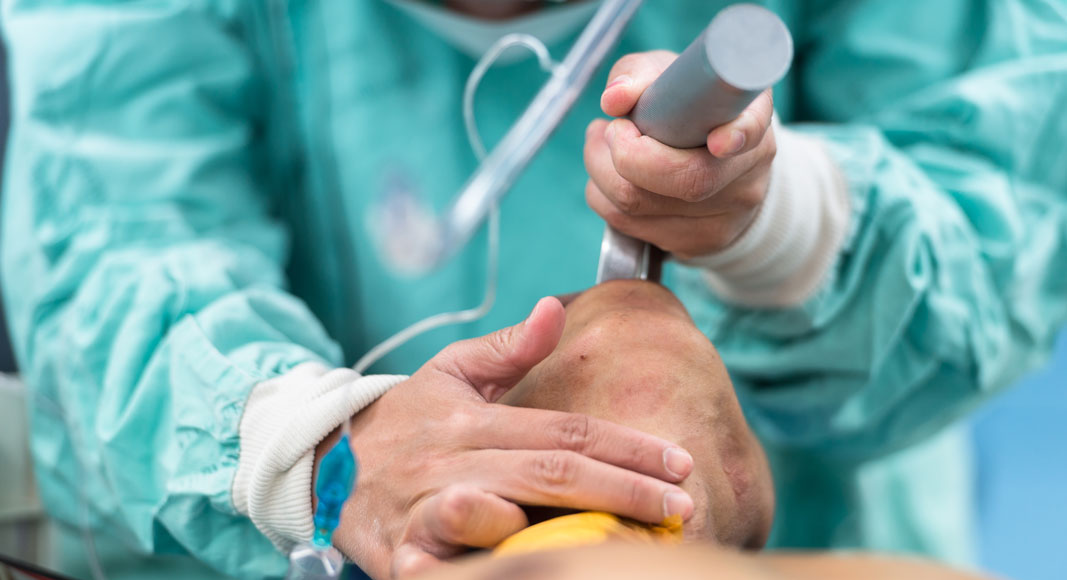 Alteraciones vocales secundarias por intubación prolongada