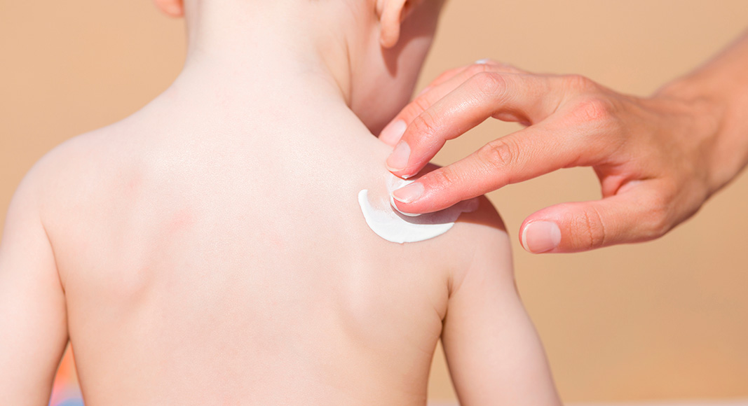 Principales riesgos en la playa para el bebé: quemadura solar