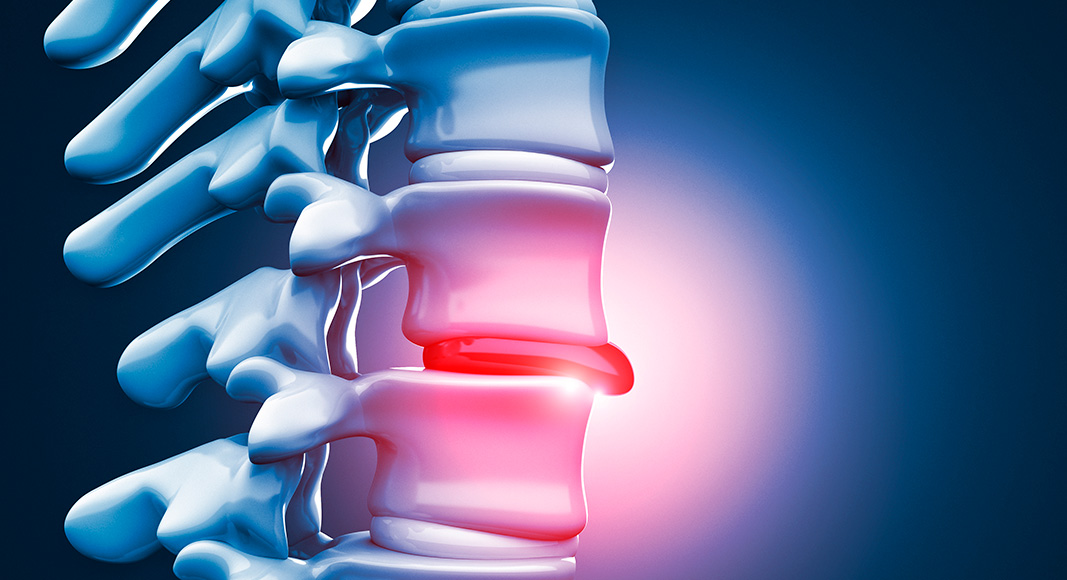 Causas de la radiculopatía: hernia
