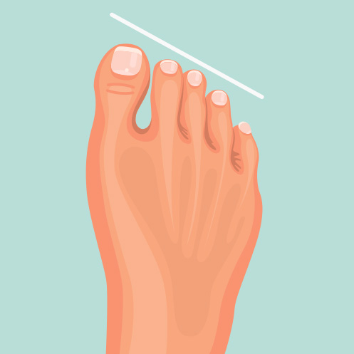 Tipos de pie: pie egipcio