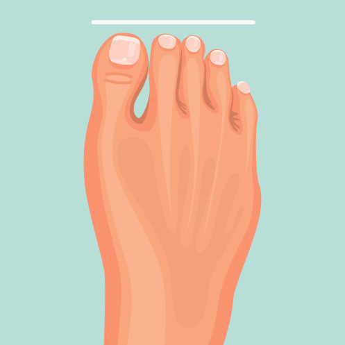 Tipos de pie: pie romano