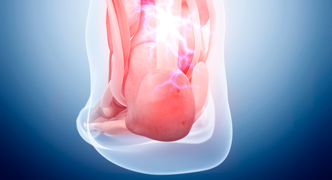 Causas de lesión del tendón de Aquiles: traumatismo