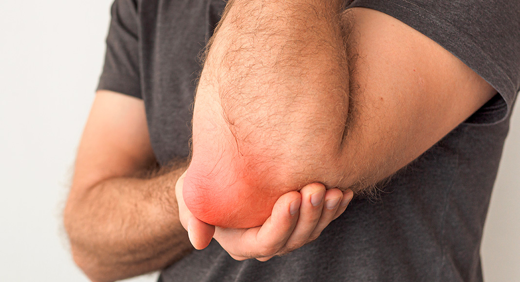 Bursitis en el codo de causa inflamatoria
