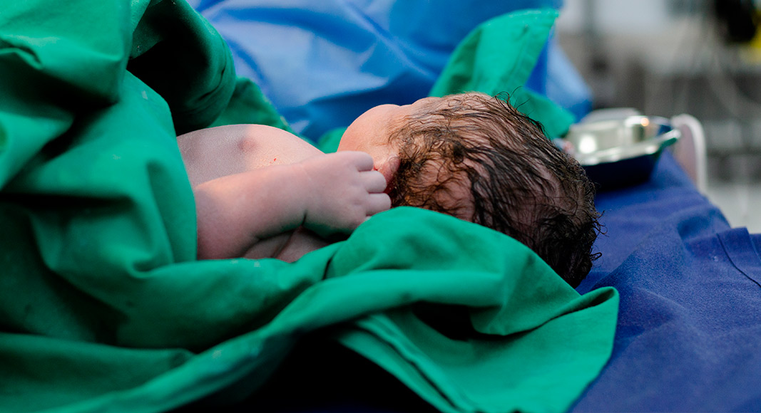 Tipos de neumonía neonatal: vertical