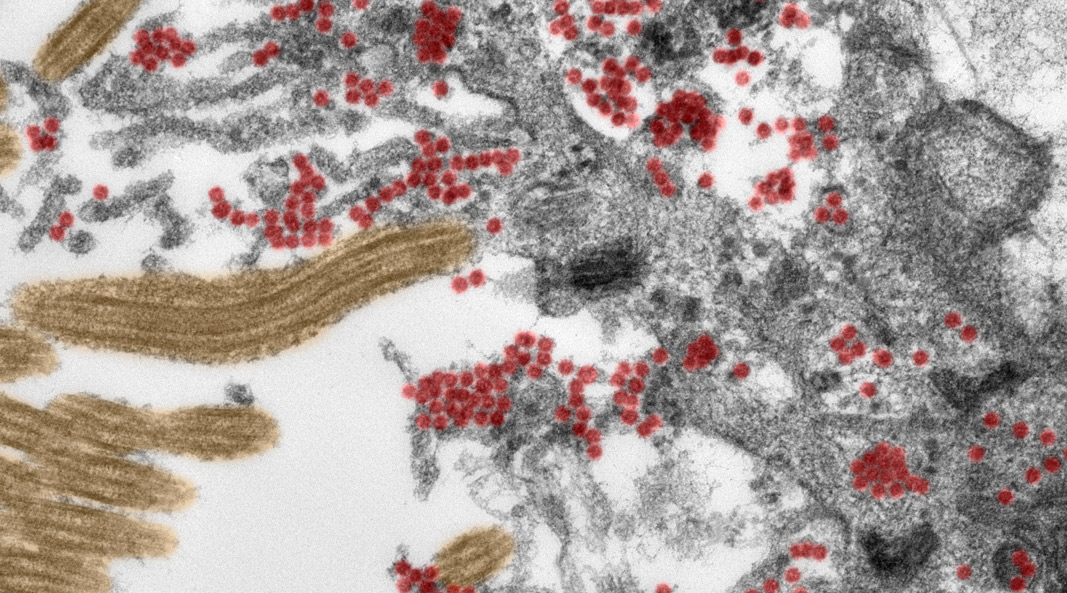 el SARS-CoV-2 se introduce en el cerebro humano a través de las células nerviosas de la mucosa olfatoria,