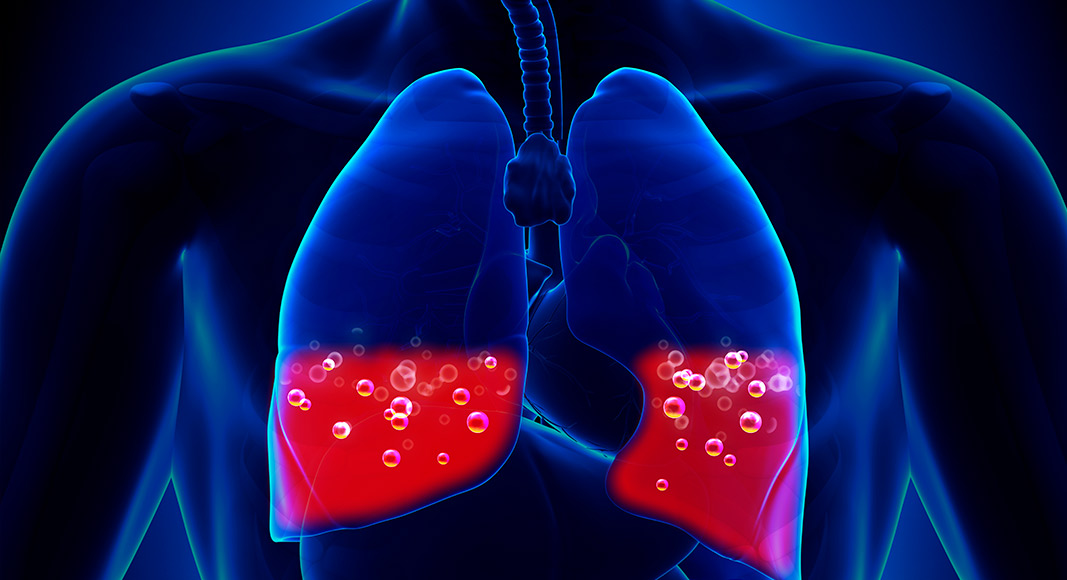 Edema pulmonar, una emergencia médica