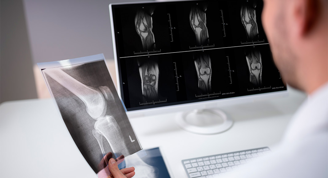 Diagnóstico del esguince de rodilla