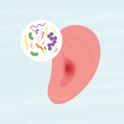Otitis media por infección de bacterias