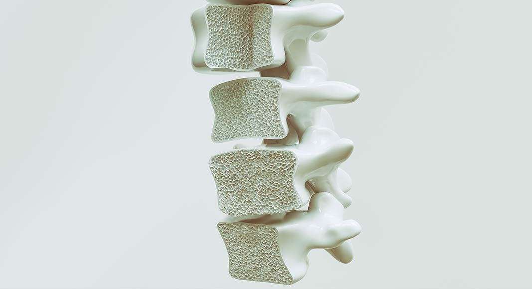 Columna vertebral afectada por la osteoporosis