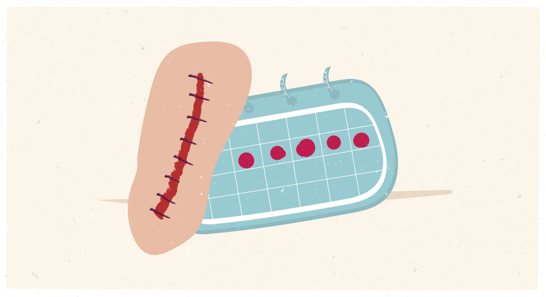 Cuidar la herida en el posparto