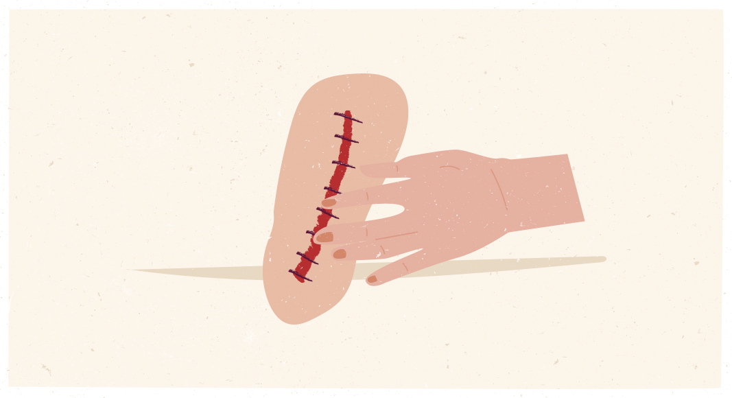 Puntos infectados en el posparto