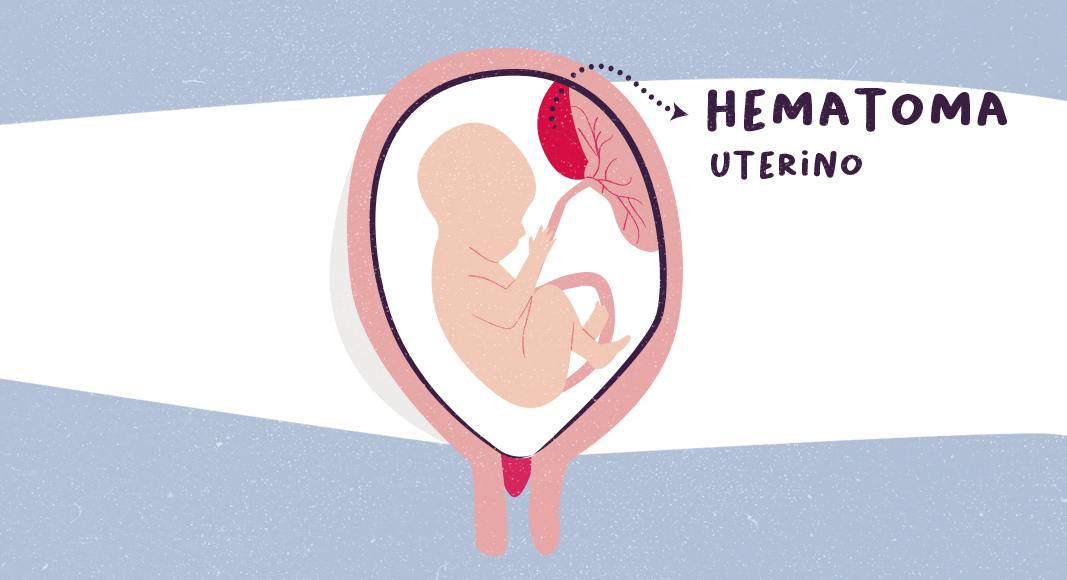 Hematoma uterino