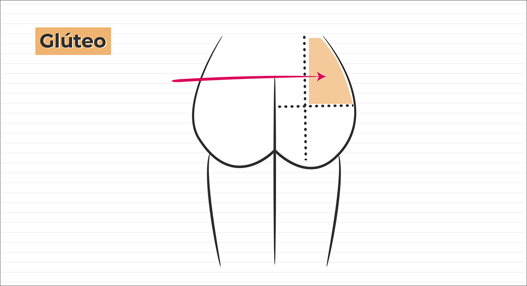Inyección intramuscular en glúteo