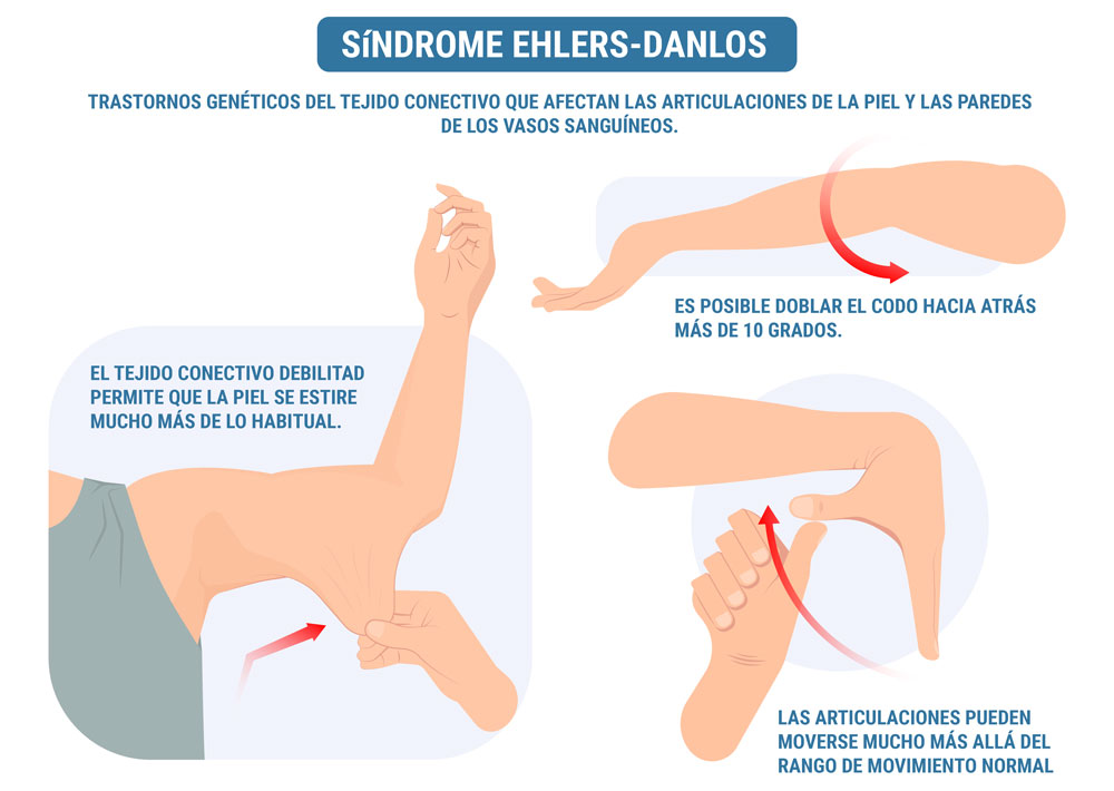 Ilustración con los síntomas del síndrome Ehlers-Danlos