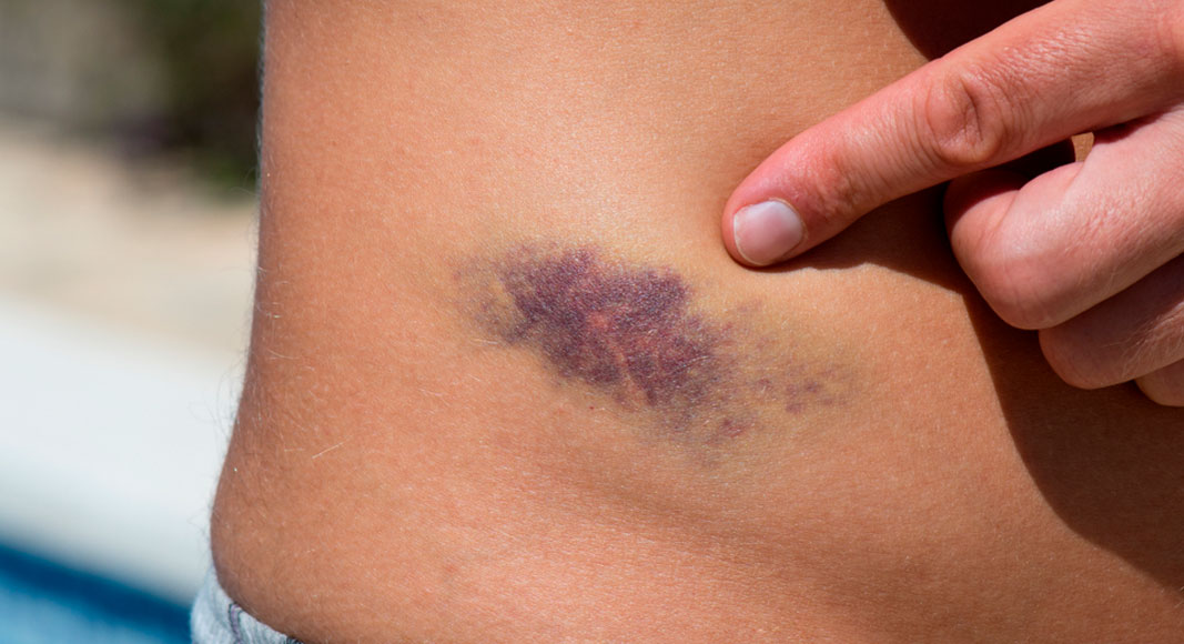 Contusiones más comunes: manos