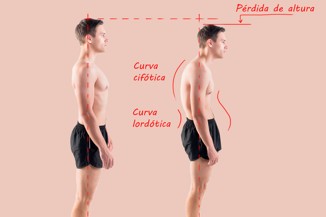 Curvatura de la espalda con la edad y pérdida de altura (ilustración) Ilustración de la curvatura de la espalda con la edad