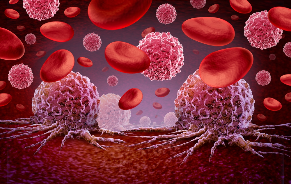 Cáncer de sangre: papel de la genética y personalización del tratamiento