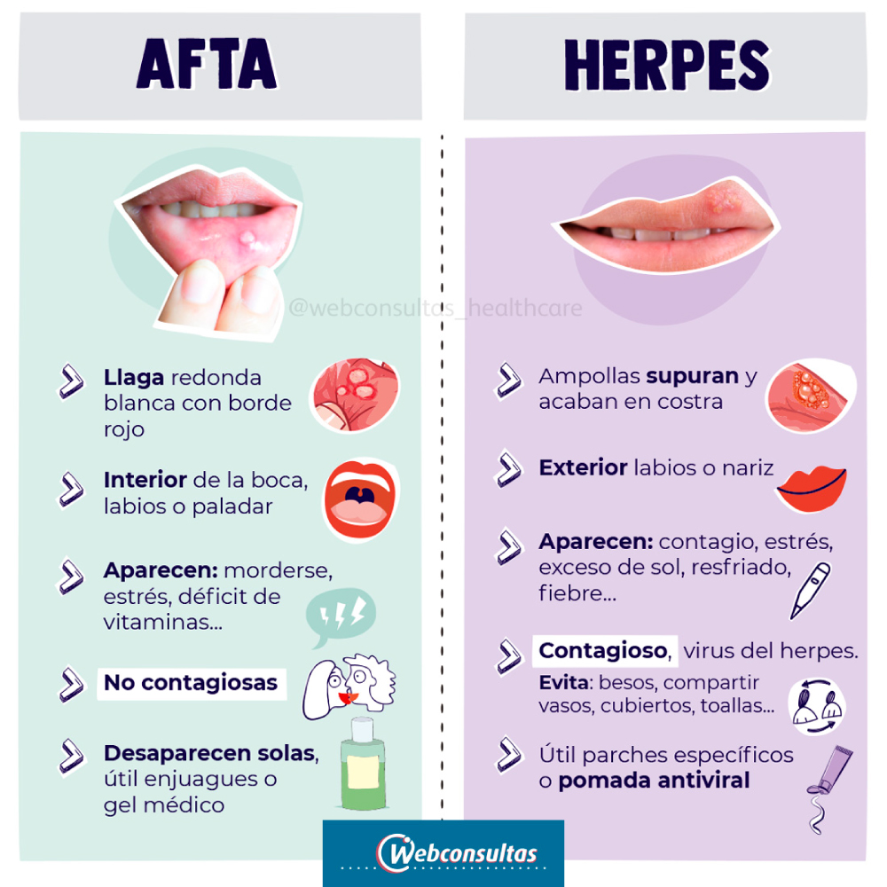 Infografía ¿Es un afta o herpes? ¿Es un afta o herpes?