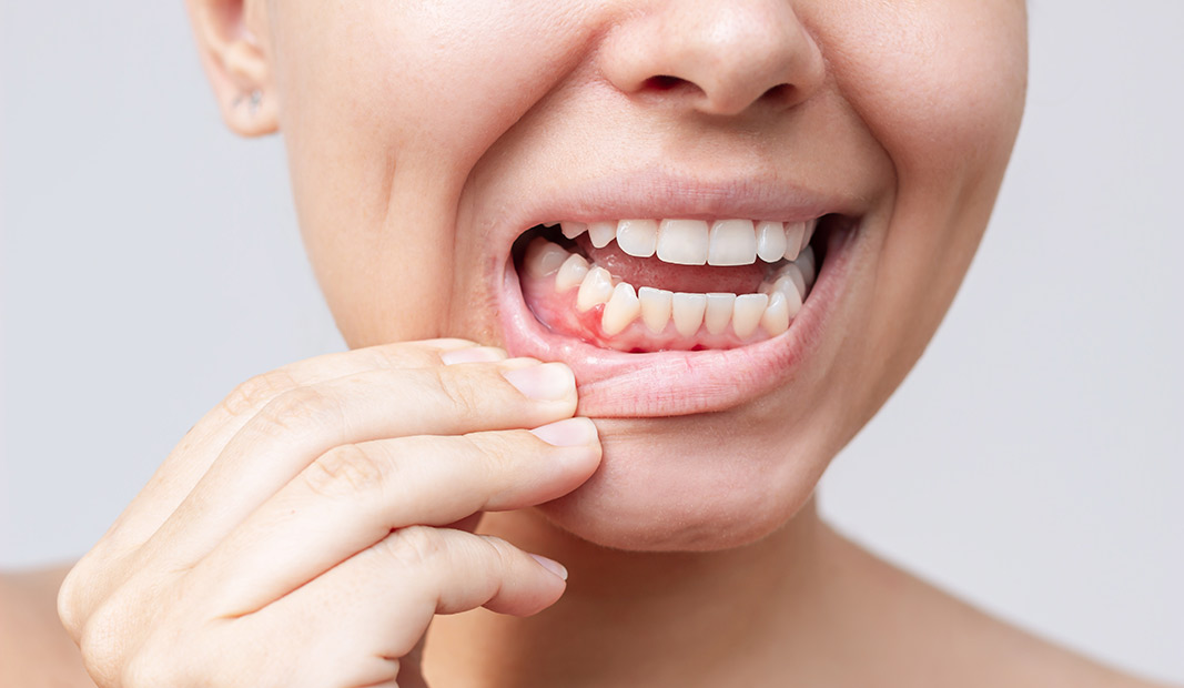 Mujer con gingivitis Mujer con gingivitis