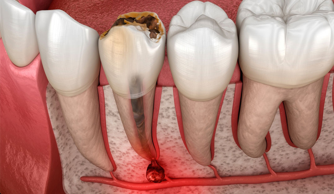 Infografía de una dentadura afectada por periodontitis