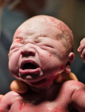 Bebé con el síndrome de dificultad respiratoria neonatal