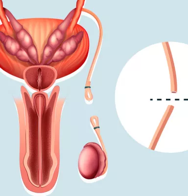 Cómo se realiza la vasectomía