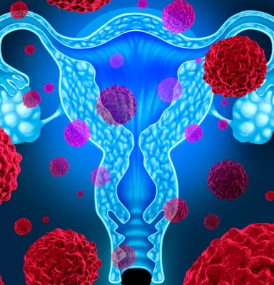 Qué es el cáncer de cuello de útero