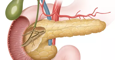 Qué son los tumores exocrinos de páncreas